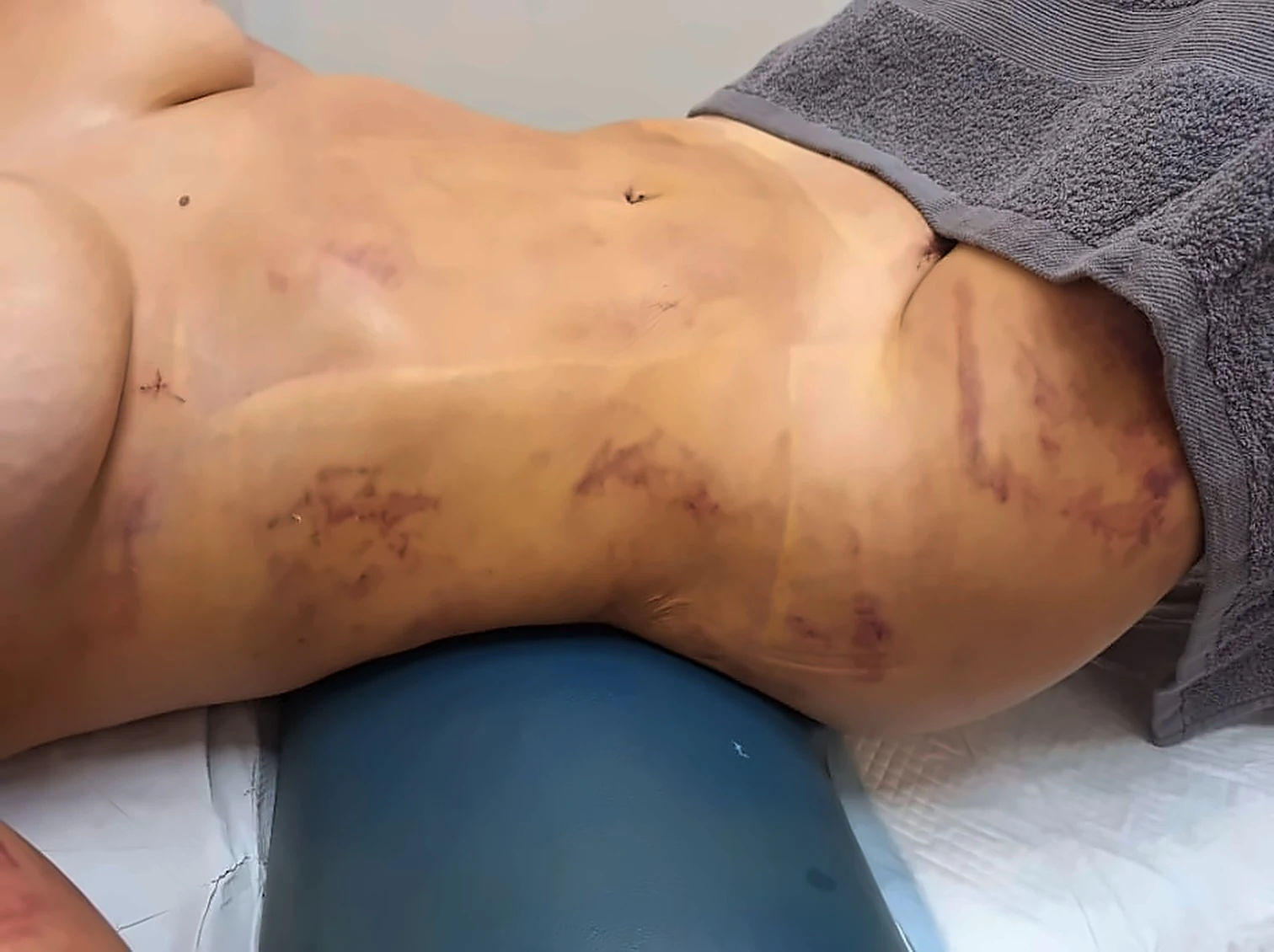 Hematomas en abdomen y flanco al inicio del postoperatorio de LipoVaser y BodyTite, antes de la rehabilitación postoperatoria en Alicante