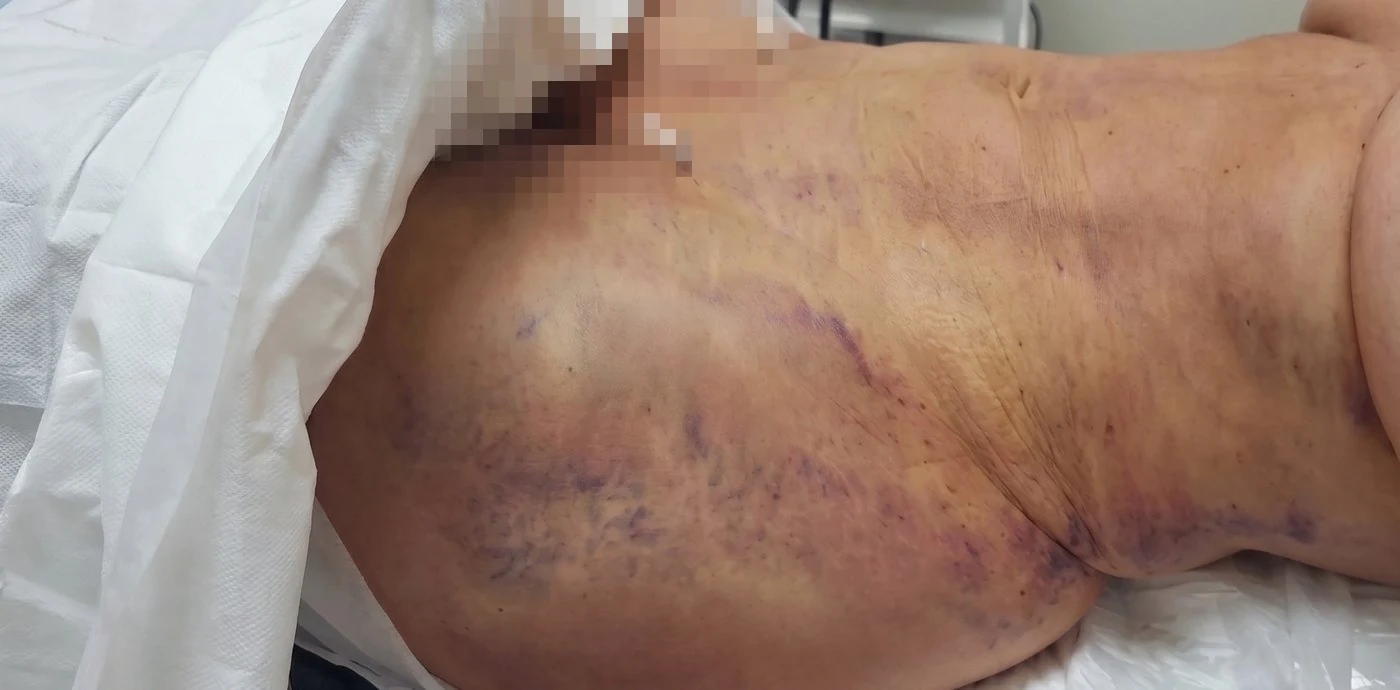 Hematomas e inflamación en abdomen y flanco en los primeros días del postoperatorio de liposucción