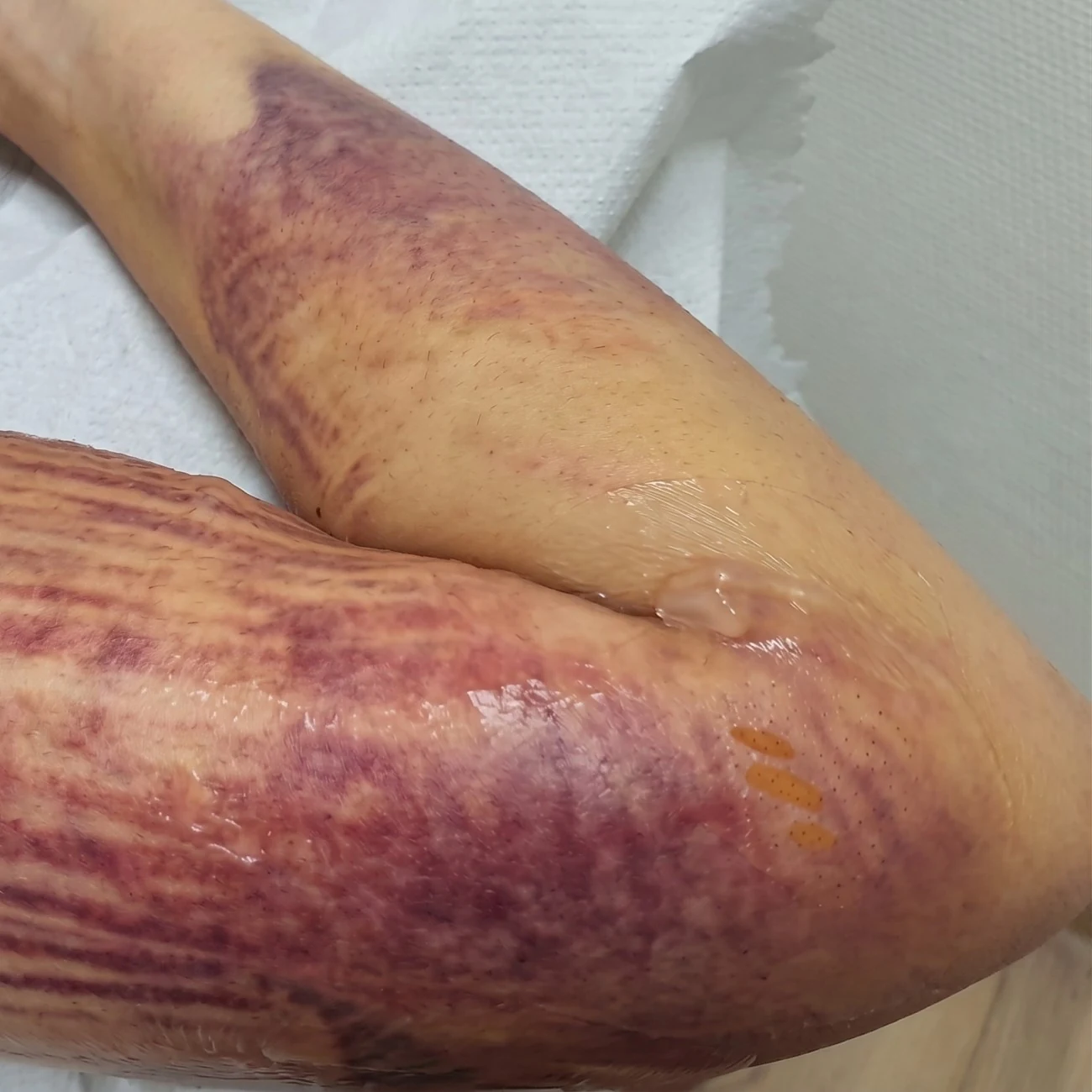 Hematomas e inflamación en el brazo tras una liposucción de brazos con LipoVaser