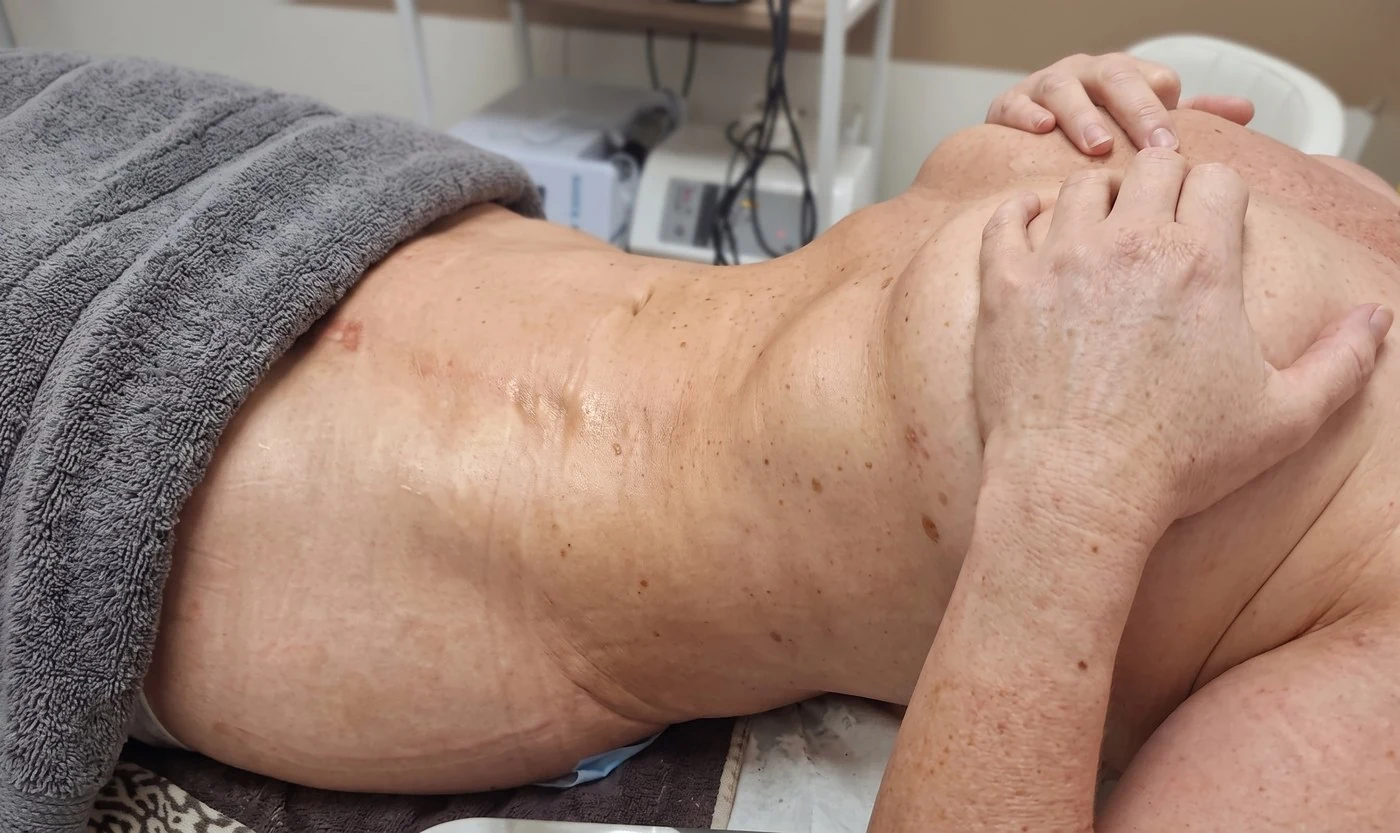 Abdomen y flanco sin hematomas tras la rehabilitación postoperatoria en Playa de San Juan, Alicante