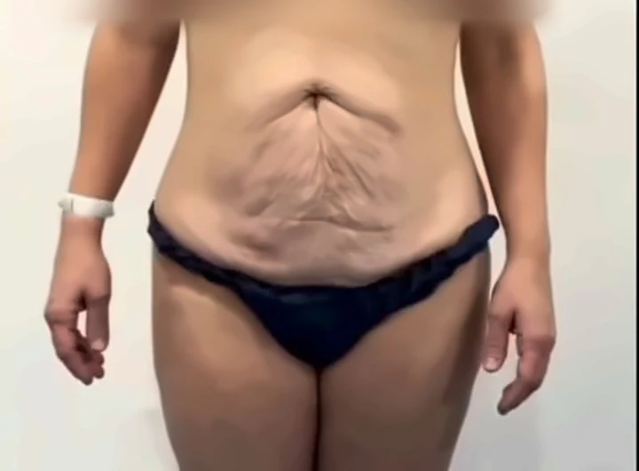 Abdomen con flacidez y estrías antes de la abdominoplastia